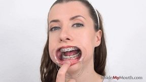 Inside My Mouth - Jennifer - Dental braces and mouth retractor! (FULLHD quality)