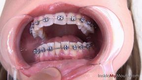 Inside My Mouth - Jennifer - Dental braces and mouth retractor! (HD quality)