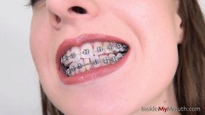Inside My Mouth - Jennifer - Dental braces clip! (MOBILE quality)