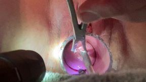 frozen sound penetrates cervix with tenaculum