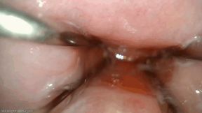 endocervical speculum extreme closeup (720 mp4)