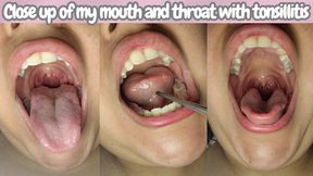 Close up of my mouth and throat with tonsillitis