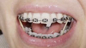 EPIC handjob with cum on BRACES and elastics!