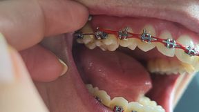 Braces and mouth with saliva fetish