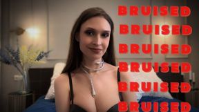B R U I S E D