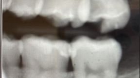 BlueberryFairy's Dental Exam: Part Three