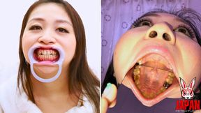 Dental Exploration: Missing Filling and a full crown Rin Suzumiya's Oral Adventure