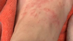foot blisters