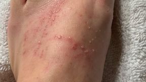 Foot Blisters 3