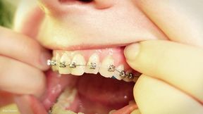 braces fetish - mouth tour close up (arya grander)