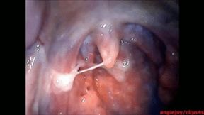 Big phlegm ENDOSCOPY wmv