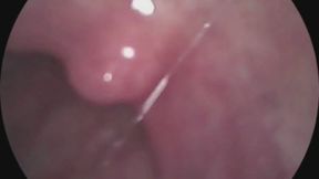 endoscope- lollipop