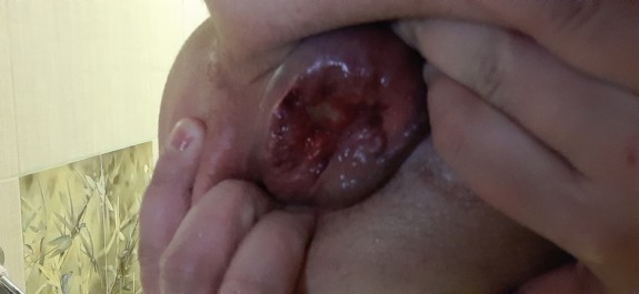 Gape anal