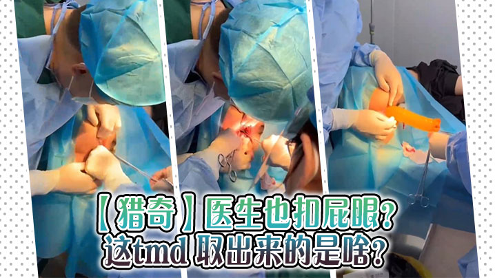 【獵奇】醫生也扣屁眼？ 這tmd 取出來的是啥？