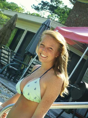 freckles